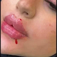 خدمات تزریق فیلر بوتاکس انزیم