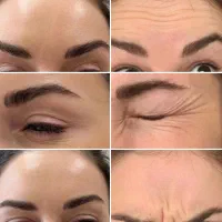 تزریق چربی ژل بوتاکس|خدمات آرایشگری و زیبایی|خرم‌آباد, |دیوار