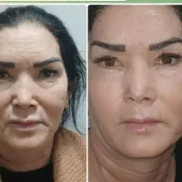هایفو ،فیشال،لاغری ،اسکالپ سر ،مزونیدلنیگ