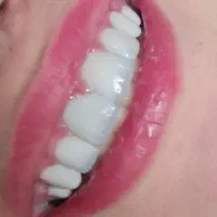 دندانپزشکی،کامپوزیت فکی۹۰۰۰،روکش ،لمینت،عصب کشیی