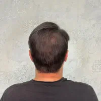 میکرواسکالپ مو، پرپشتی مو، مکمل کاشت مو|خدمات زیبایی و سلامت|کرمانشاه, |دیوار