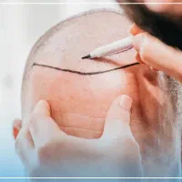 آموزش صفر تا صد کاشت مو