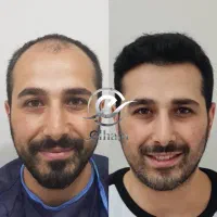 کاشت مو و ریش اقساط