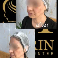 تزریقات زیبایی ژل،بوتاکس،هایفوتراپی،مزوتراپی وفیلر|خدمات آرایشگری و زیبایی|تهران, جنت‌آباد جنوبی|دیوار