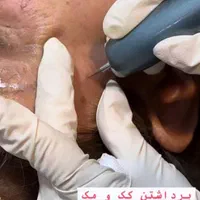تخصص ما لیزر ژل و بوتاکس حرفه ای و جوانسازی پوست|خدمات آرایشگری و زیبایی|تهران, شهرک ولیعصر جنوبی|دیوار
