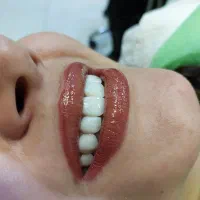 خدمات کامپوزیت و لمینیت سرامیکی شرایط اقساط ویژه