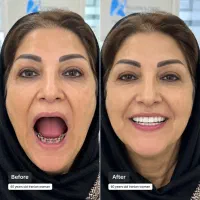 ایمپلنت یک روزه با روکش سرامیکی