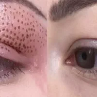 آموزش و کاشت مژه،برداشتن خال،پلاسما جت وپرسینگ|خدمات زیبایی و سلامت|اصفهان, مسجد مصلی|دیوار