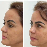 جشنواره هایفوتراپی صورت و غبغب بادستگاه ۱۲بعدی گلد