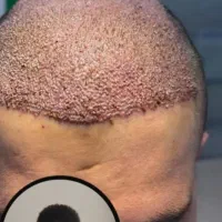 تخفیف کاشت مو