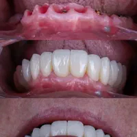 ایمپلنت.لمینیت.اقساطی۱۲ماهه.بدون بهره.تبریز