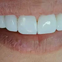 تخفیف 50 درصدی کامپوزیت و دندان پزشکی|خدمات آرایشگری و زیبایی|تهران, ایوانک|دیوار