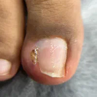 فرورفتگی ناخن توگوشت|آرایشی، بهداشتی، درمانی|انار, |دیوار