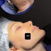 افتادگی پلک،بلفاروپلاستی،سانترال لب،بوکال فت،غبغب|خدمات آرایشگری و زیبایی|تهران, پاسداران|دیوار