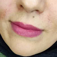 تزریق ژل وبوتاکس|خدمات آرایشگری و زیبایی|قم, بکایی|دیوار