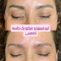ابرو/لیزر پوست /شیدینگ/لیزر مو سفید/درمان کبد چرب|خدمات آرایشگری و زیبایی|خرم‌آباد, |دیوار