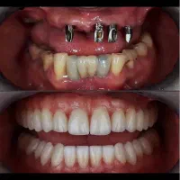 ایمپلنت دندان اقساط ۶تا۲۴ماه دندانپزشکی کامپوزیت