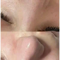 خدمات و اموزش فشیال (پاکسازی صورت)|خدمات آرایشگری و زیبایی|کرمانشاه, |دیوار