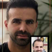 کاشت مو ابرو و ریش تارکوب