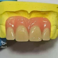 دندانسازی ساخت دندان مصنوعی متحرک باضمانت