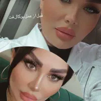 جشنواره ساکشن غبغب/بوکال فت/زاویه سازی دائم|خدمات زیبایی و سلامت|تهران, نظامی گنجوی (توانیر)|دیوار