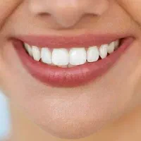 دندانپزشکی کامپوزیت لامینت قسطی