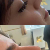 لیزر ژل وبوتاکس وخالبرداری سم زدایی|خدمات آرایشگری و زیبایی|تبریز, |دیوار