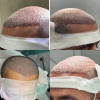 خدمات کاشت مو و ابرو به صورت اقساط|خدمات آرایشگری و زیبایی|شیراز, معالی‌آباد|دیوار