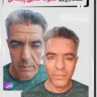 مرکز تخصصی تزریق فول فیس چربی و فیلر/لیفت با نخ