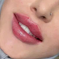 جشنواره تزریق بوتاکس و ژل فیلر چانه گونه زاویه لب|خدمات آرایشگری و زیبایی|فردیس, فردیس|دیوار