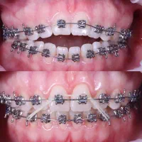 ارتودنسی اقساطی بدون چک معاینه رایگان|خدمات آرایشگری و زیبایی|اندیشه, شهرک صدف|دیوار