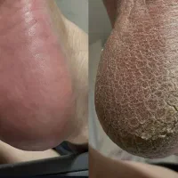 پدیکور تخصصی(باهزینه موادفقط)