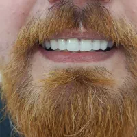 پروتز متحرک دندان|آرایشی، بهداشتی، درمانی|گنبد کاووس, |دیوار