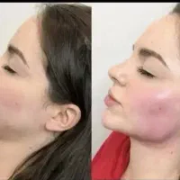 تزریق تخصصی ژل و بوتاکس|خدمات آرایشگری و زیبایی|سبزوار, کوی بهار|دیوار