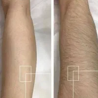 لیزر موهای زاید با جدیدترین دستگاه کاملا بدون درد