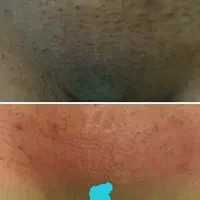 سفیدکننده بیکینی (طی ۷ روز)