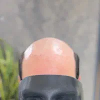 پروتز مو مردانه و زنانه