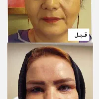 بلفاروپلاستی ، ژل ، بوتاکس|خدمات زیبایی و سلامت|تبریز, |دیوار