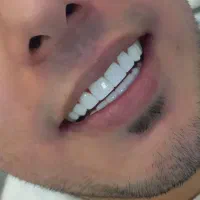 دندانپزشکی ، روکش، کامپوزیت