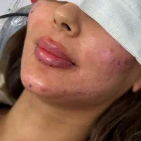 ژل بوتاکس خالبرداری|خدمات آرایشگری و زیبایی|زابل, |دیوار