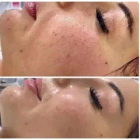خدمات ریموو تتو صورت وجوانسازی صورت|خدمات آرایشگری و زیبایی|اصفهان, شهرک ولیعصر|دیوار