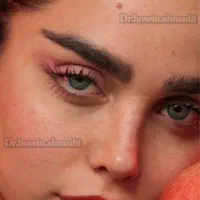 عمل جراحی بینی بادستگاه پیزوبدون درد،کبودی،خونریزی