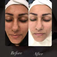 مدل برای پاکسازی پوست|استخدام درمانی، زیبایی، بهداشتی|تبریز, |دیوار