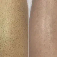 تنها لیزر تضمینی با ضمانت برگشت وجه