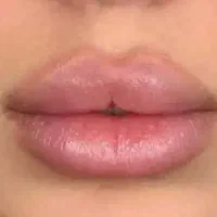 تزریق فیلر (ژل) و بوتاکس