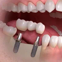 ایمپلنت کره 7900 ضمانتی