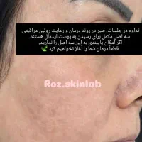 درمان انواع لک و اسکار با روش پکینگ آپ گاز