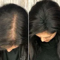 آب رسانی برای فولیکول