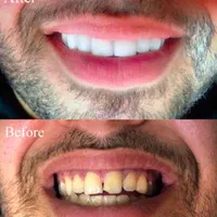 انجام خدمات جرمگیری دندان و ترمیم دندان های پوسیده|خدمات آرایشگری و زیبایی|آبادان, |دیوار