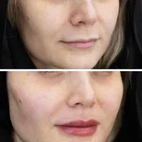 تخفیفات ویژه ژل و بوتاکس